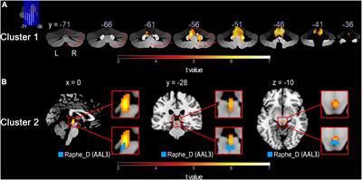 Altered cerebral blood flow in patients with spinocerebellar degeneration